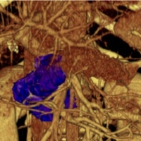 3D volume rendering image of the pancreas.