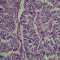 Microscopy section from the spleen showing the neuroendocrine tumor