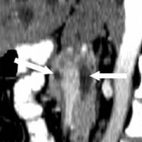 Pancreatic ducts on either side of the portal vein