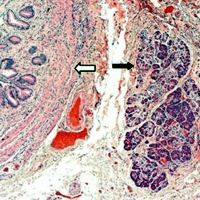 Features of chronic cholecystitis and pancreatic heterotopic tissue