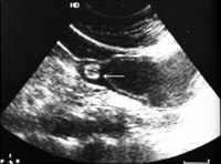 A two-layered pattern of the wall of the duplication cyst