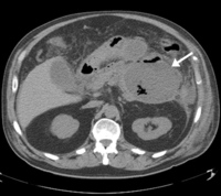 Necrotizing pancreatitis with air-fluid levels