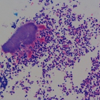 Basophilic spherical mass with a radiating border of eosinophilic clubs