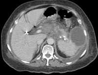 A mass of the pancreas invading the nearby surrounding soft tissues