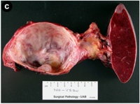 Gross surgical resection specimen