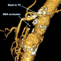 Changes in functioning arterial collaterals after celiac trunk stenting