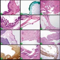 Cystic lesions of the pancreas