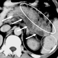 Multiple abscesses in the body and tail regions of the pancreas, splenic vein thrombosis and splenic micro-abscesses
