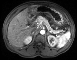 MRI of the abdomen with contrast: prominent inflammatory changes surrounding the pancreas, with no necrosis or pseudocyst formation