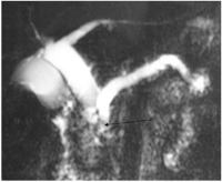 Type Ic choledochal cyst