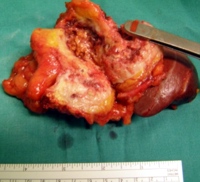 Cystic necrotic center of the metastatic tumor from cancer of the descending colon