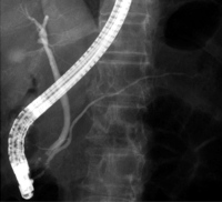 ERCP: There is no anomalous arrangement of the pancreaticobiliary ducts or any anomaly of the pancreatic ducts