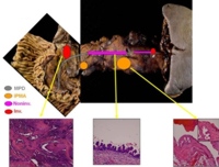 Schematic representation of the location of IPMNs and non-invasive and invasive ductal carcinomas.