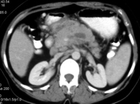 CECT showing the bulky head and body of the pancreas with heterogeneous areas of non-enhancement suggestive of necrosis and peripancreatic fat stranding