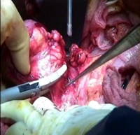 Excision of the second part of duodenum