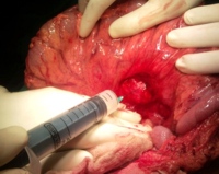 Cyst decompression by aspiration