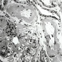 Renal biopsy: glomeruli with a global increase in the mesangial matrix