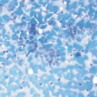 Pancreatic acinar cell cluster with lymphocytes and plasma cells in the background