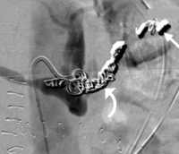 Digitally subtracted angiographic image showing occlusive embolisation coils placed in the splenic artery