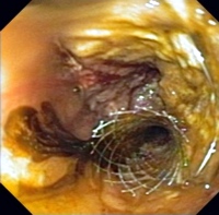 Deployed metal biliary stent protruding through mesh of duodenal wall stent