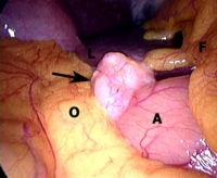 Intraoperative laparoscopic appearance of prepyloric antral lesion