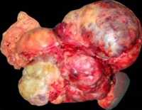 Large lobulated mass in relation to the body and tail of the pancreas