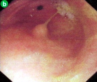 Solid, sessile polypoid mass under the intact overlying mucosa in the gastric antrum