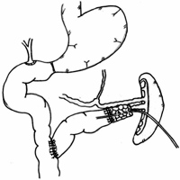 The end result of middle-preserving pancreatectomy with double jejunal loop reconstruction