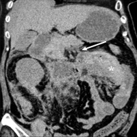 Jejunal hematoma and an irregular slightly swollen pancreatic body with peripancreatic fat streaking