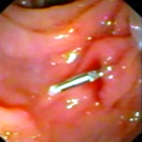 The application of a hemoclip on the Dieulafoy’s lesion