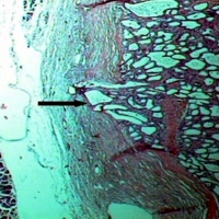 Section of serous microcystic adenoma in the pancreatic head