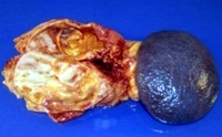 Gross appearance of the cystic tumor in the pancreas tail