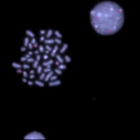 Image: Trisomy 21 chromosome - Down syndrome