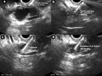 Linear endoscopic ultrasound showing EUS-guided brushing of a cystic pancreatic lesion