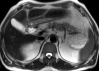 T2-weighted axial MR image showing a complex mass consisting of multiple sub-centimeter nodules, with a "cheerios-like" appearance