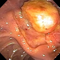 Images from the ERCP demonstrate a large, irregular, friable, soft mass at the ampulla