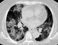 Chest CT showing bilateral diffuse ground-glass opacities in both lungs