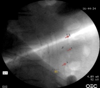 EUS-guided fiducial placement in a patient with locally advanced pancreatic cancer
