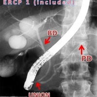 Large hepatic cystic lesions communicating with the bile ducts