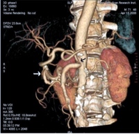 Celiac artery stenosis with tortuous pancreaticoduodenal arcade