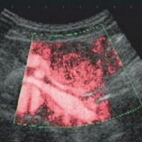 Contrast-enhanced US shows partial enhancement at the solid component