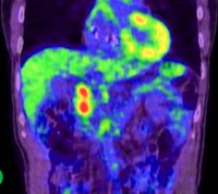 FDG-PET showing a hot spot at the cut end of the pancreatic head