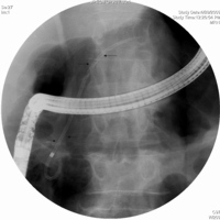 ERCP showing the 7F, 10 cm long pancreatic stent traversing the main duct stricture extending to the tail