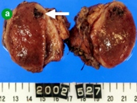 Well-circumscribed solid mass with hemorrhagic degeneration