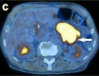 Original attenuation-corrected coronal PET image