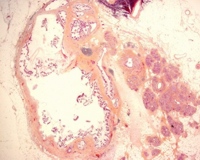 Pancreatic ducts lined by tall, columnar, mucin-containing epithelium with papillary projections