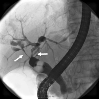 ERCP by using a balloon catheter showing a longer stretch of stenosis in the hilar hepatic region
