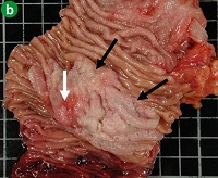 Large exophytic duodenal tumor situated in and around the ampulla of Vater