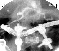 Radiographic image showing endoscope in position passed retrograde