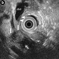 Hypoechoic focal lesion of the pancreatic head at radial scanning EUS